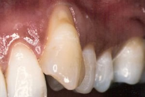 Gingival graft for root coverage before